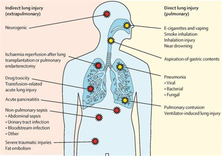 
Sean Cardovillis Illness Lung Complications Pneumonia Linked To Death 